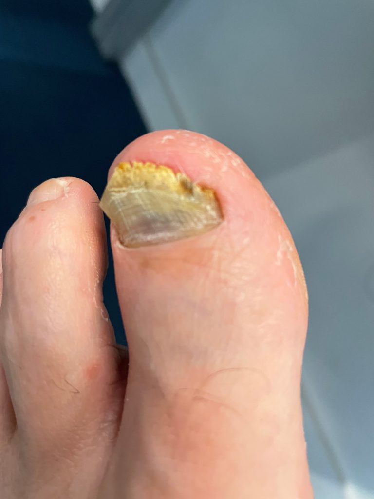 Nasty Toe After Wearing Too Small Basketball Shoes