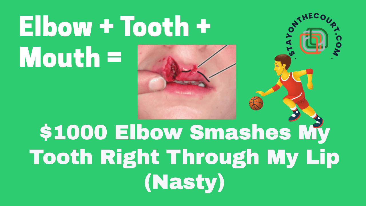 Elbow Smashes My Tooth Right Through My Lip