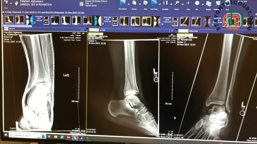 X - rays of an ankle on a computer screen.