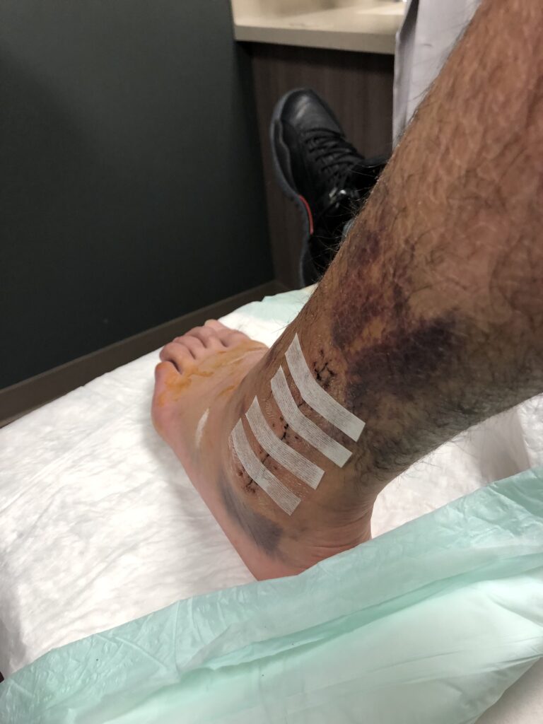 Al Peterson's foot with a bandage after surgery.  Very swollen and black and blue bruising on it.
